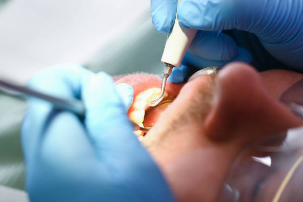 Best Emergency Tooth Extraction in Loudonville, NY